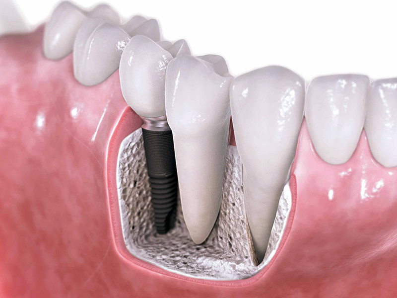 dentalni implantat