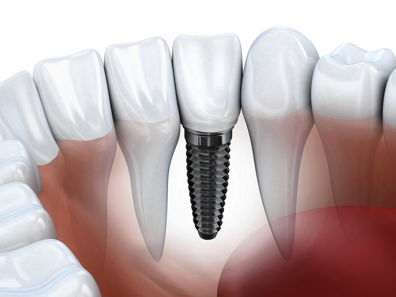 implantat vjestacki korijen zuba